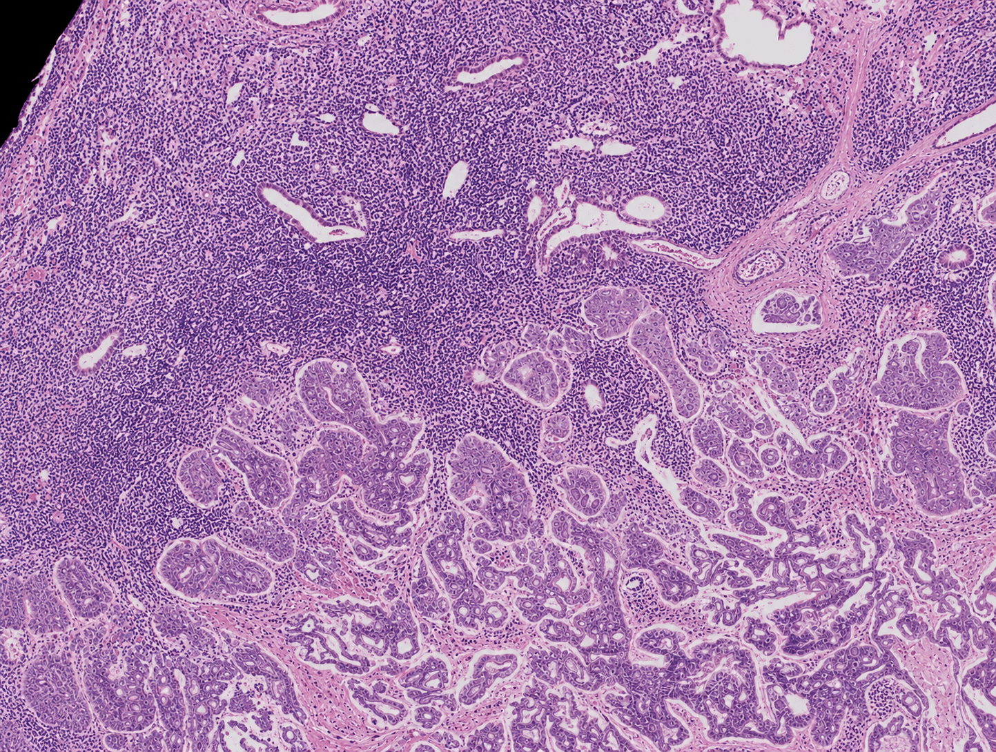 H&E whole-slide image with tumor and stroma regions marked