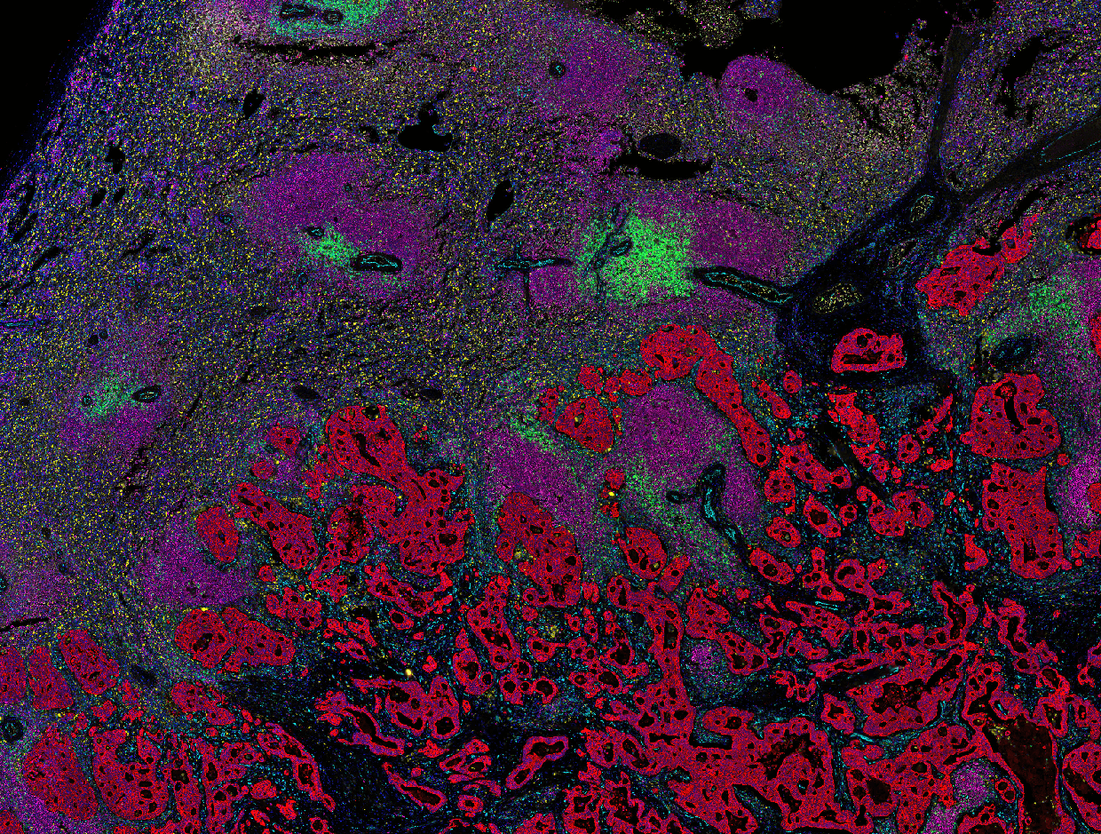 60-marker mIHC whole-slide image with tumor and stroma ROIs mapped